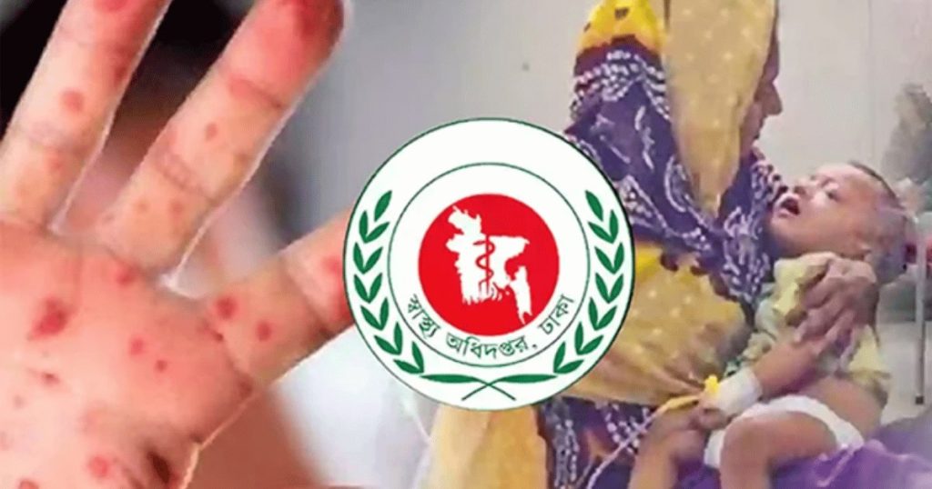 সিলেটে হাম উপসর্গে আরও ৪ শিশুর মৃত্যু, মোট ১৬৪ জনের মৃত্যু