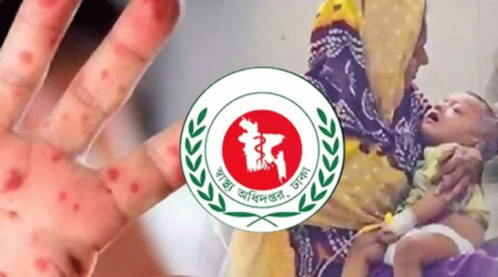 সিলেটে হাম উপসর্গে আরও ৪ শিশুর মৃত্যু, মোট ১৬৪ জনের মৃত্যু